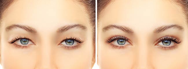 eyelid surgery in Worcester | Blepharoplasty in Cape Cod