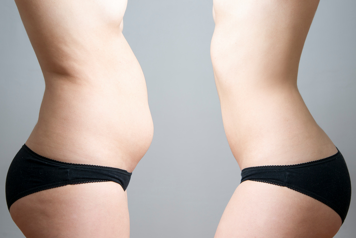 liposuction before after