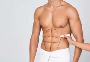 Man's Fit Torso With Surgical Lines On His Body Before Operation