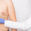 Male breast reduction