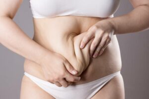 A cropped shot of a woman pinching her stomach fat before a tummy tuck