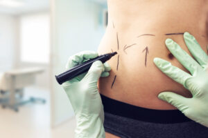 Close up of woman’s abdomen as plastic surgeon marks her body to prep for body contouring surgery.