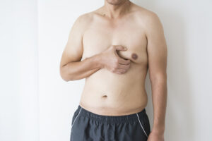 Man with gynecomastia holds chest in Worcester, MA