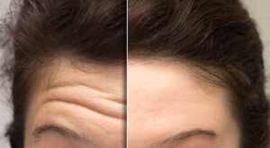 Close-up of a woman’s face showing before and after results of a cosmetic treatment to smooth forehead expression lines, highlighting anti-aging and rejuvenation benefits