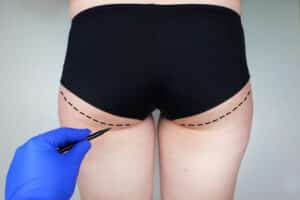 Patient consulting with a plastic surgeon about femoroplasty, cruroplasty, buttock endoprosthetics, and gluteoplasty procedures.