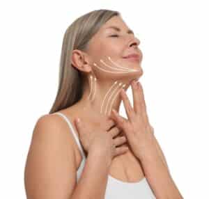 Woman with flawless skin and lifting arrows on her neck and face after cosmetic treatment, illustrating neck lift results.