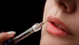 Close-up of lip filler injection for lip augmentation, enhancing lip volume and shape to achieve beauty standards.