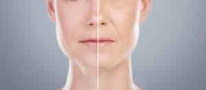 Facelift collage, before-and-after of woman’s face for skincare, anti-aging, beauty, surgery, and dermatology.