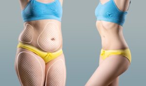 Before and after of woman’s abdomen on gray background, showing tummy tuck, liposuction, and cellulite removal plastic surgery results