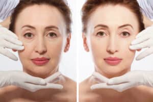 Woman before and after facial filler treatment showing a smoother under-eye area